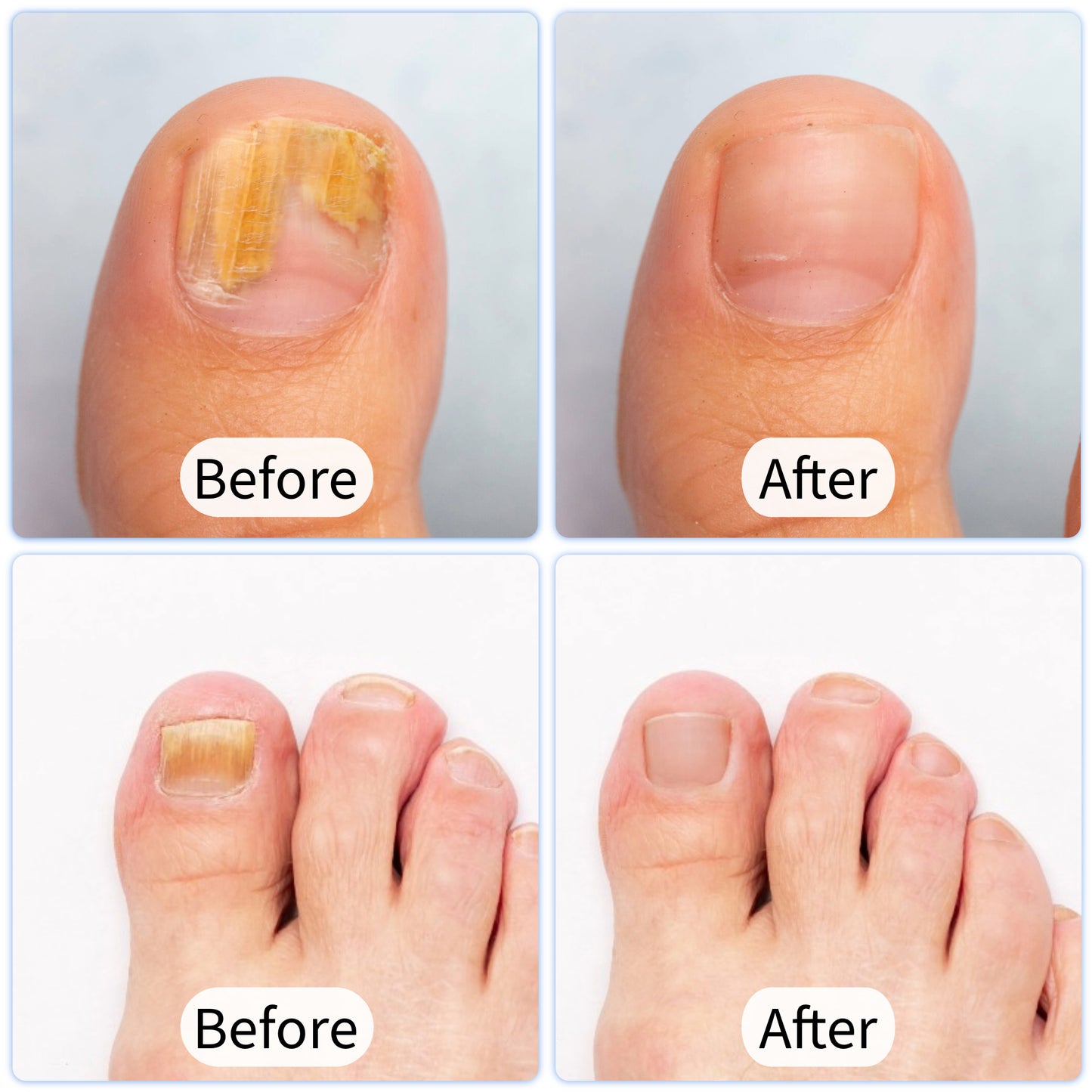 DermaLase