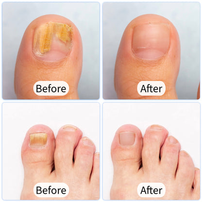 DermaLase