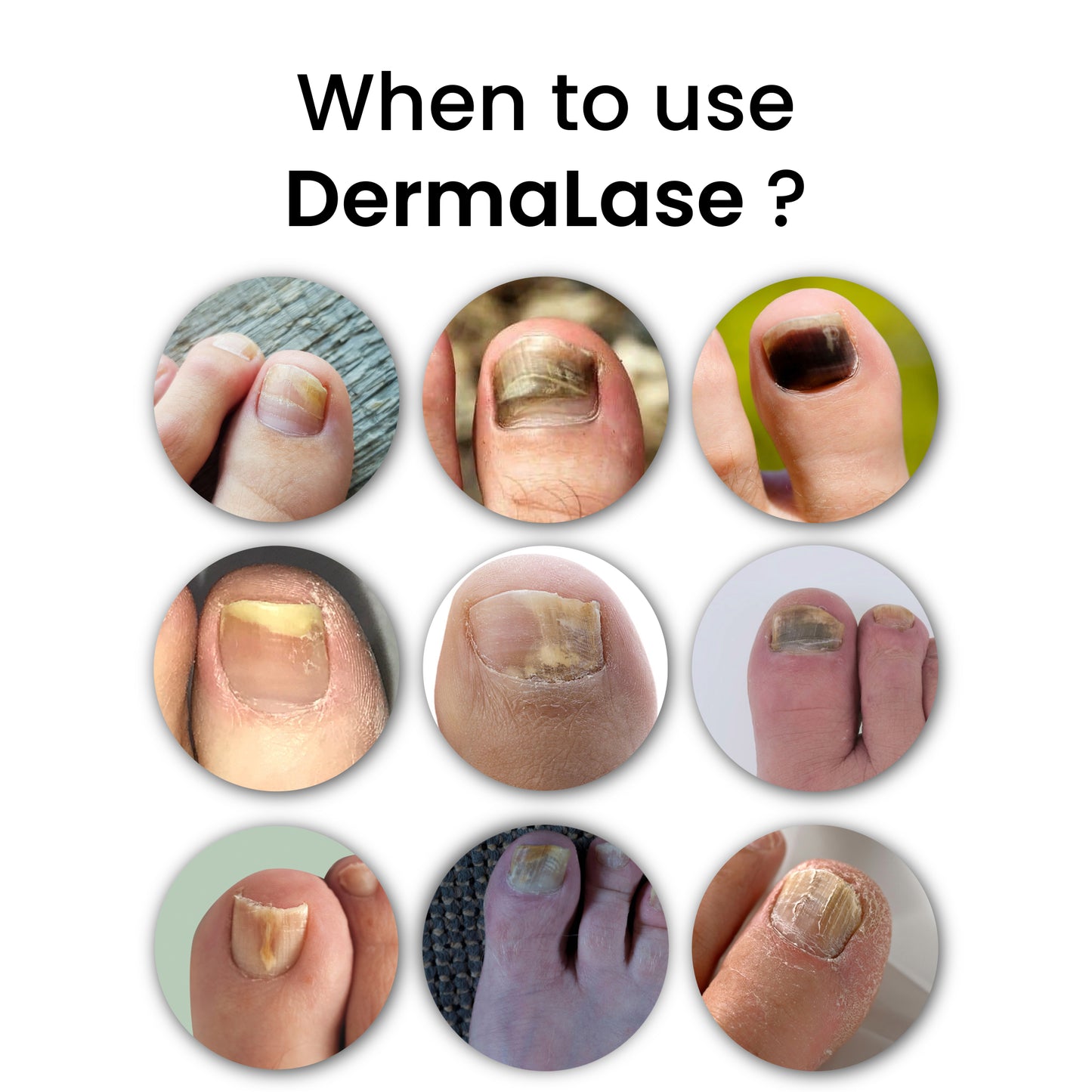 DermaLase